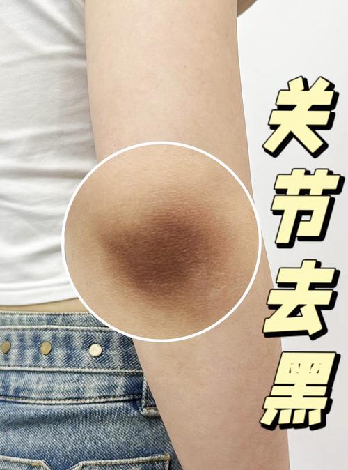 膝盖黑会不会是有风湿