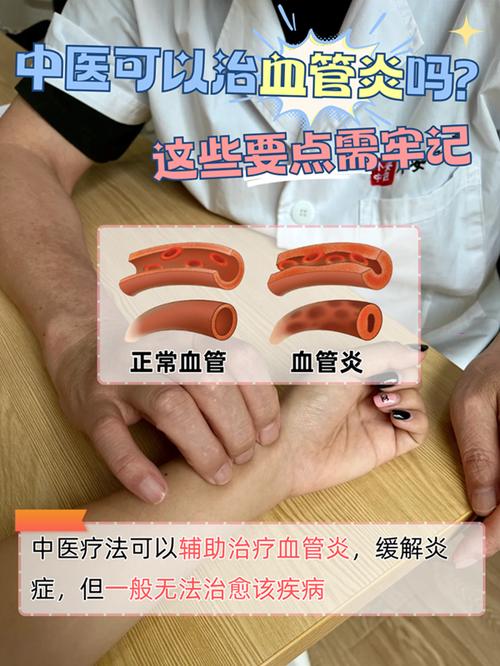 类风湿血管炎能治好吗