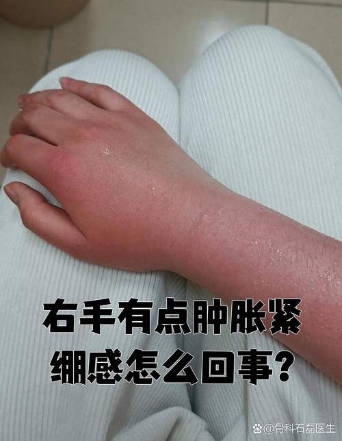 类风湿关节炎手部表现