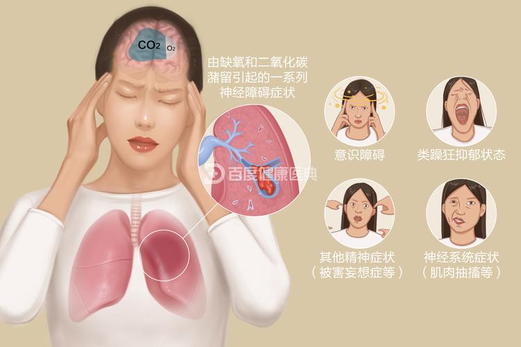 脑梗为何总并发肺感染