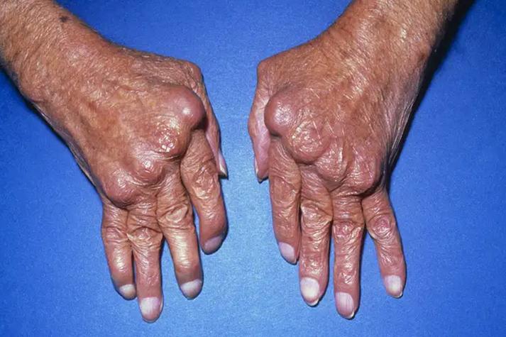 类风湿关节炎早期表现