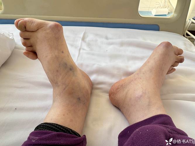 类风湿关节炎早期表现