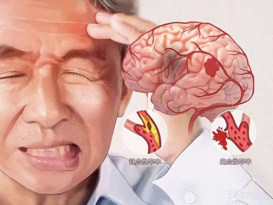 脑梗病人越来越没力气