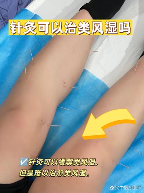 类风湿关节炎打针治疗