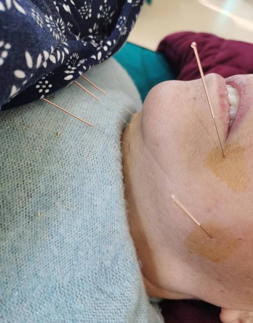 轻微脑梗针灸有效果吗