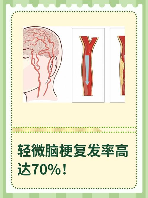 轻微脑梗复发率有多高