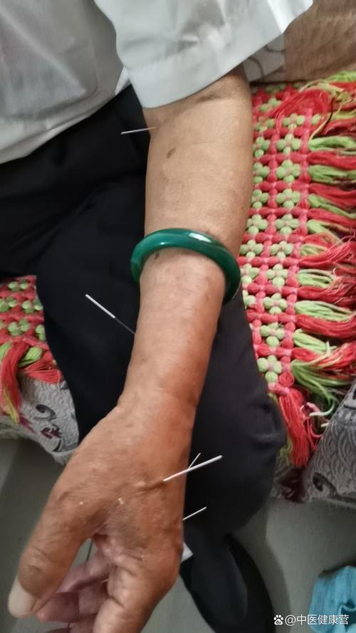 类风湿关节炎可以扎针