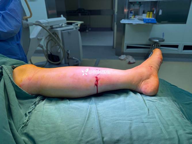 腿骨折手术与脑梗关系