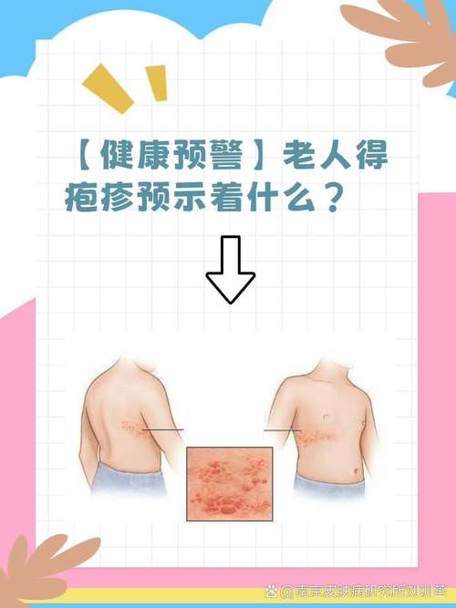 疱疹和风湿病有关系吗