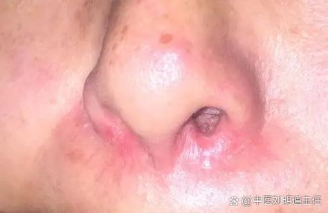 右侧脑梗 鼻唇沟变浅