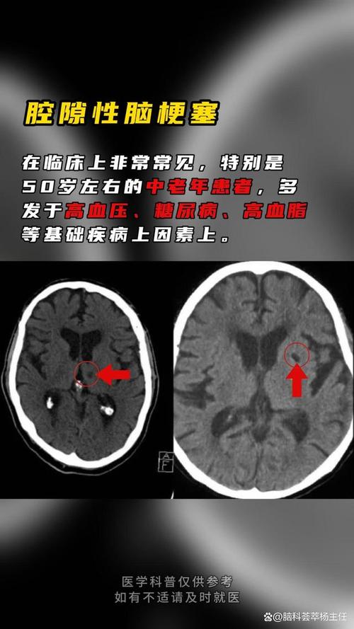 腔隙性脑梗mri表现