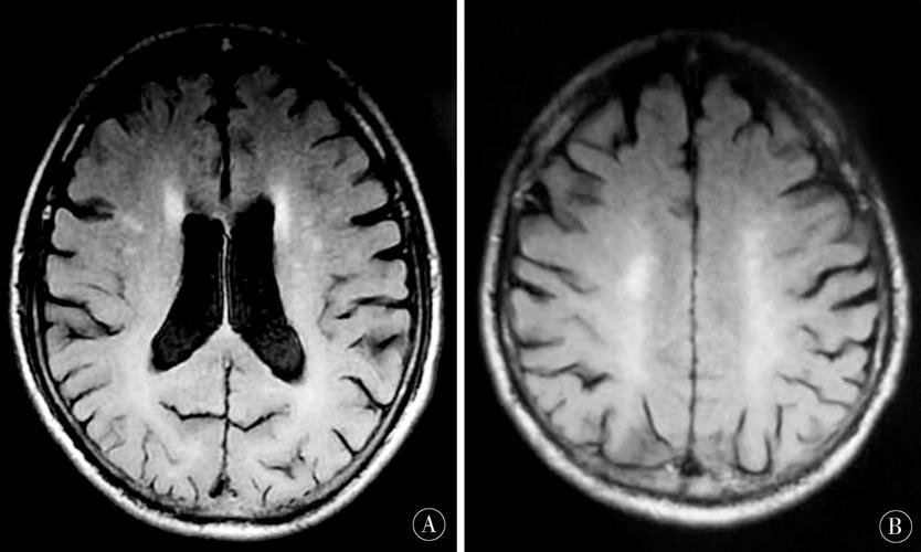 腔隙性脑梗mri表现