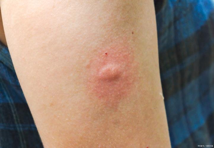 类风湿并发症身上长包