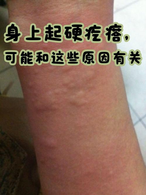 类风湿并发症身上长包