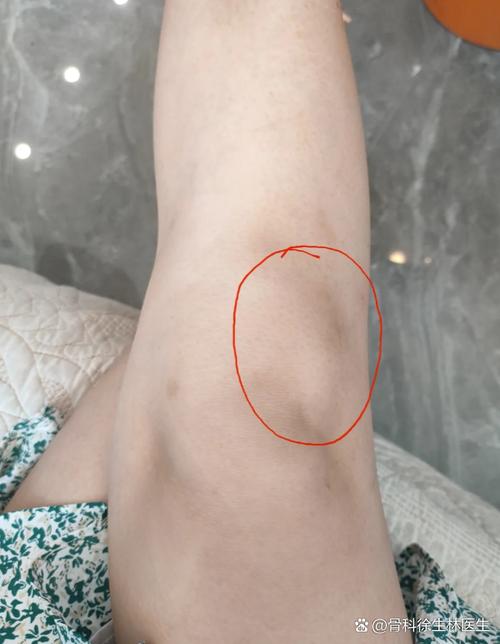 类风湿并发症身上长包