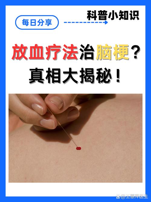 艾灸对脑梗有效果分享