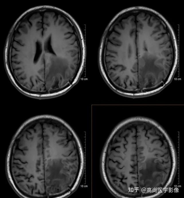 脑梗与脑肿瘤CT区别