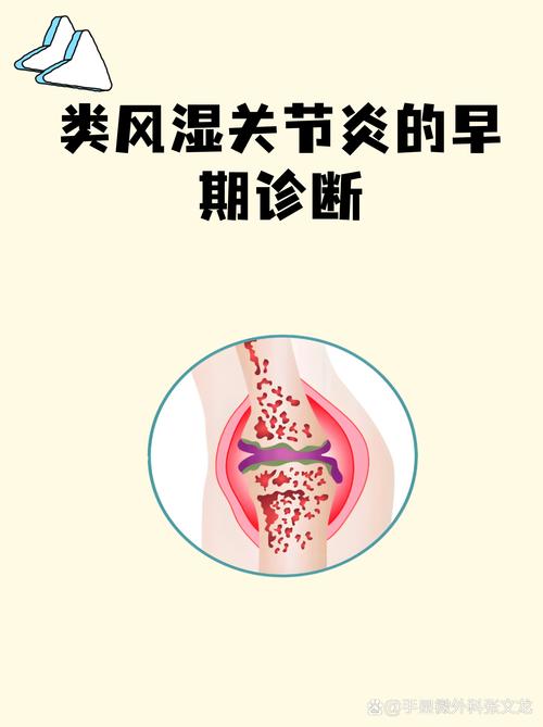 怎样诊断类风湿关节炎