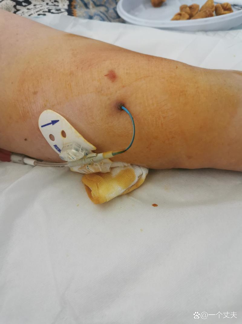 风湿性心脏病手术钢丝