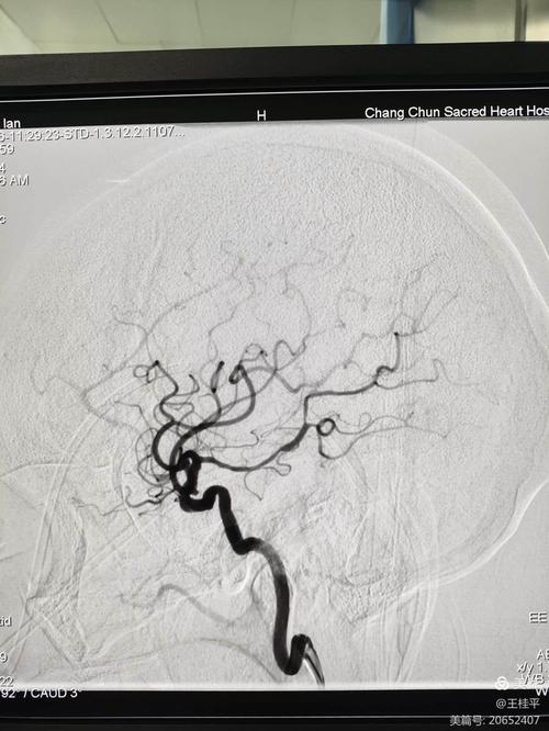 脑梗有必要做cta吗