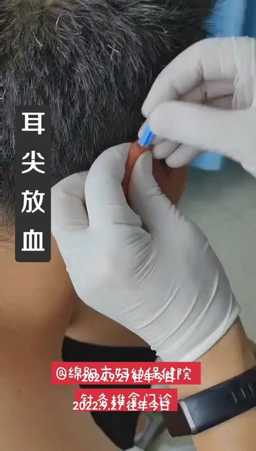 脑梗割舌头放血能好吗