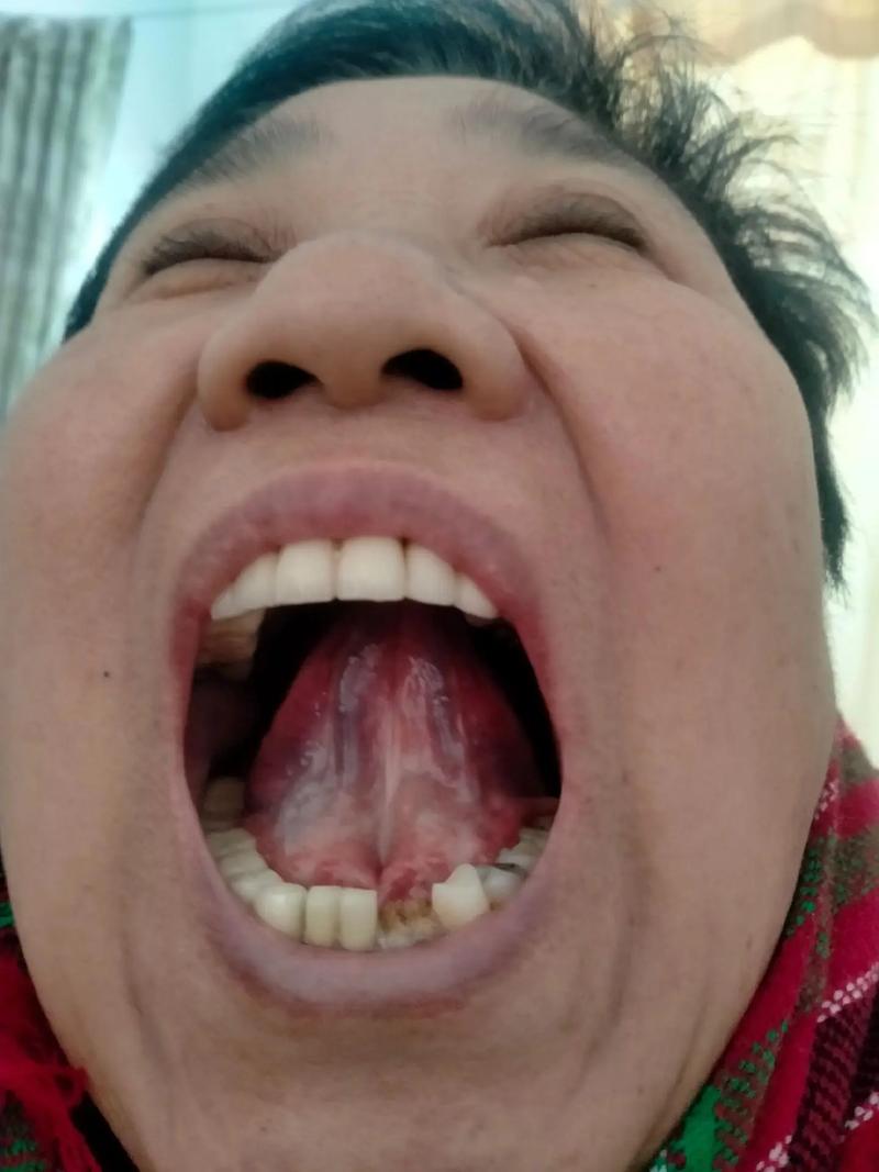 脑梗割舌头放血能好吗