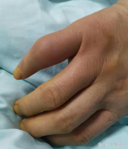 风湿病手痛是什么症状