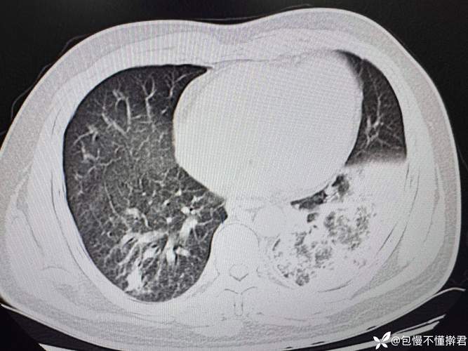 脑梗呼吸衰竭肺部感染