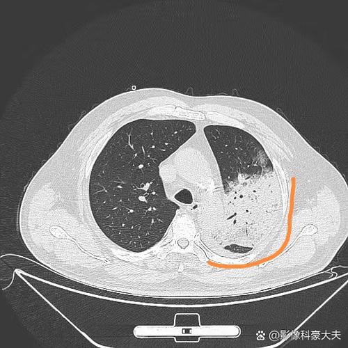 脑梗呼吸衰竭肺部感染