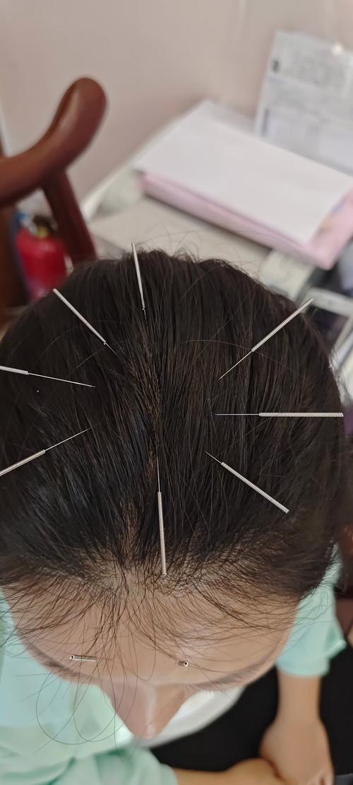 脑梗疏通血管扎什么针