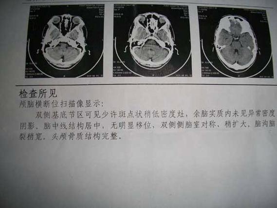 脑梗24小时ct变化