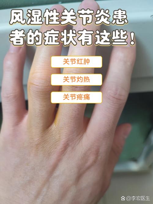 关节炎风湿症状有哪些