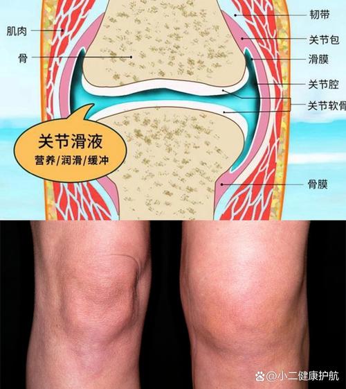 类风湿关节炎膝盖积水