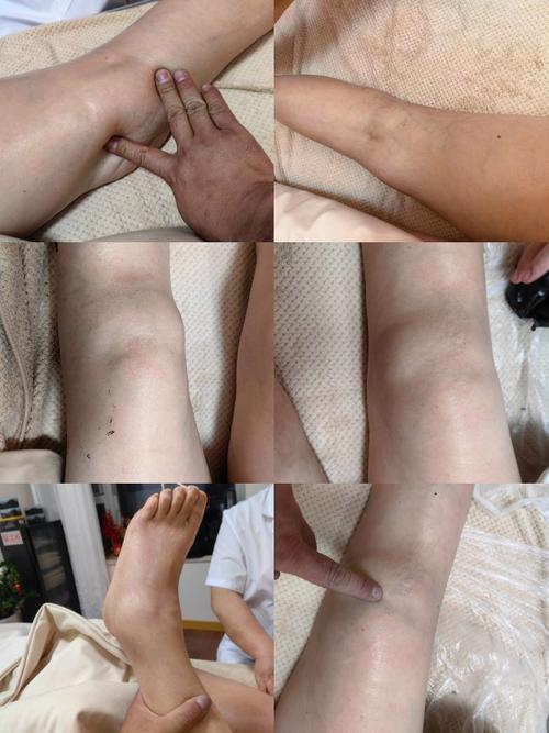 类风湿关节炎膝盖积水