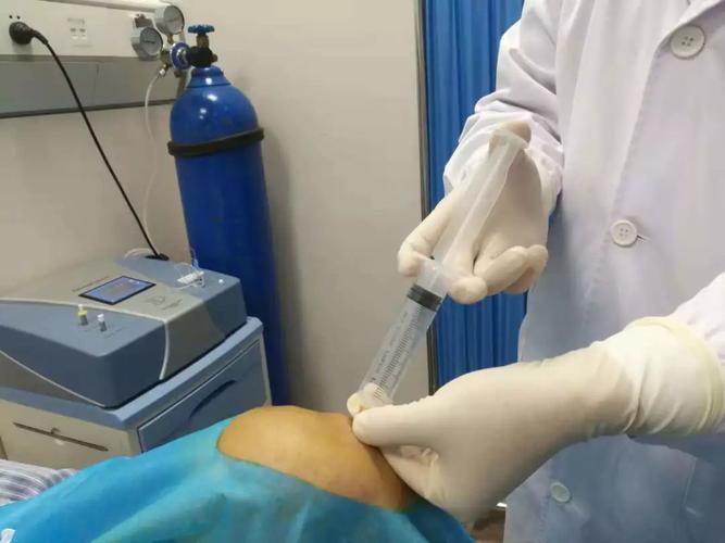 臭氧治疗类风湿关节炎