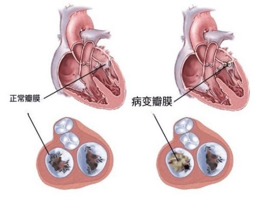 风湿性心脏合并瓣膜病