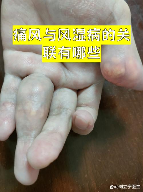 类风湿和痛风有关系吗