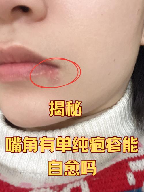嘴唇周围起泡 穴位