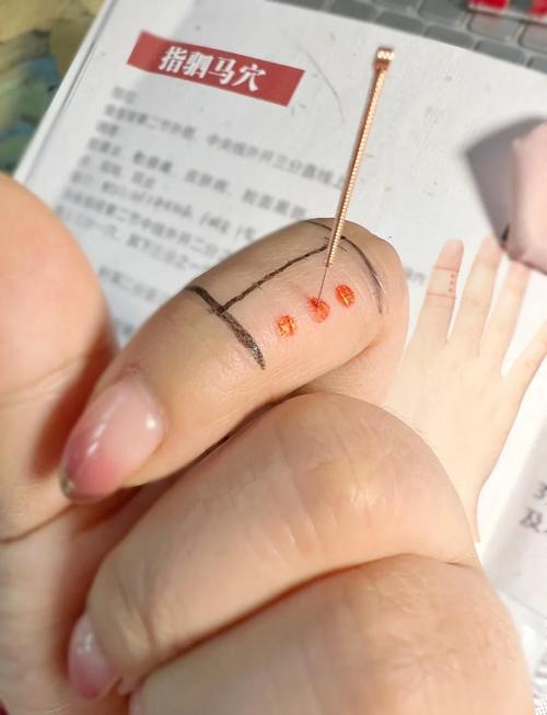 手掌疼针炙什么穴位