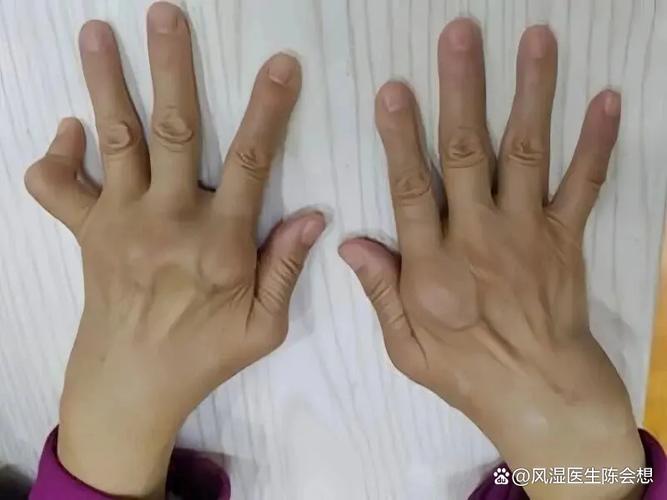 类风湿变形还能效正吗
