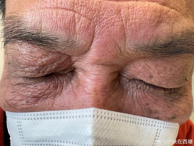 左边黑眼圈严重 脑梗