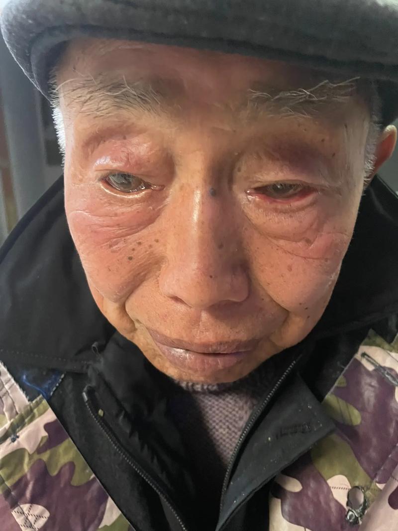 左边黑眼圈严重 脑梗