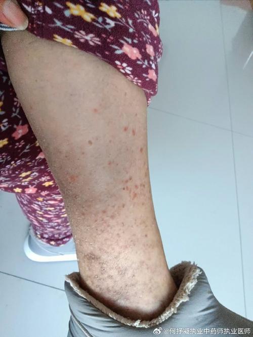 脑梗患者为什么身上痒