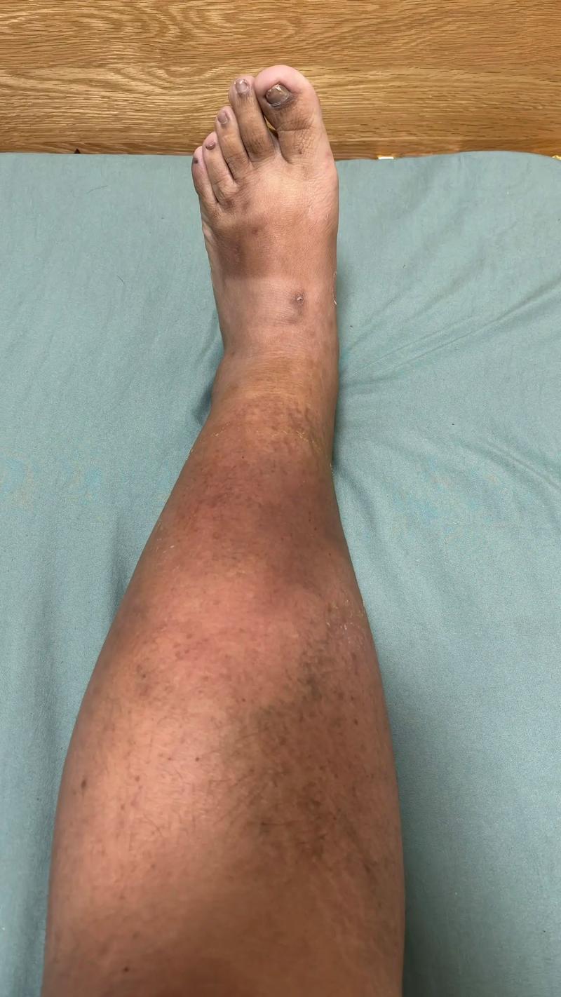 因为类风湿脚会变黑么