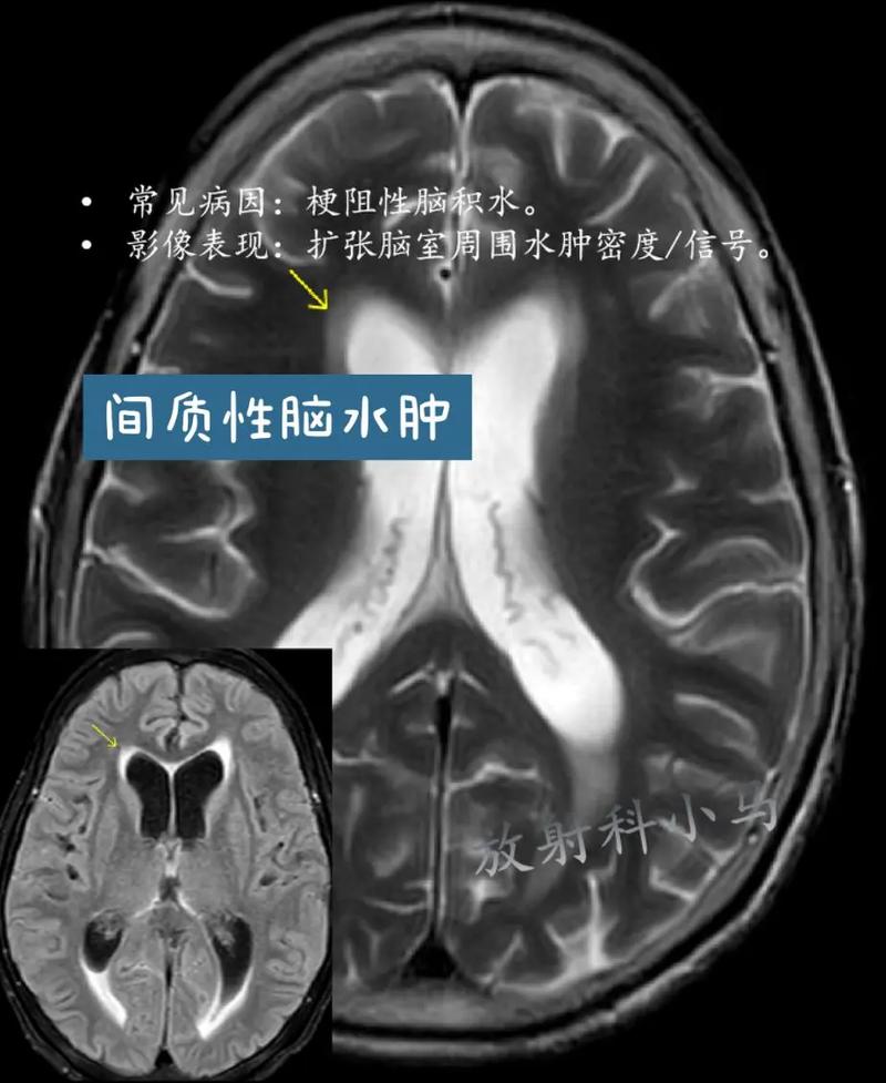 脑梗脑积水症状有哪些