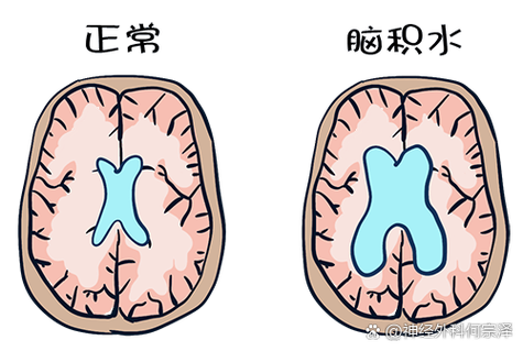 脑梗脑积水症状有哪些