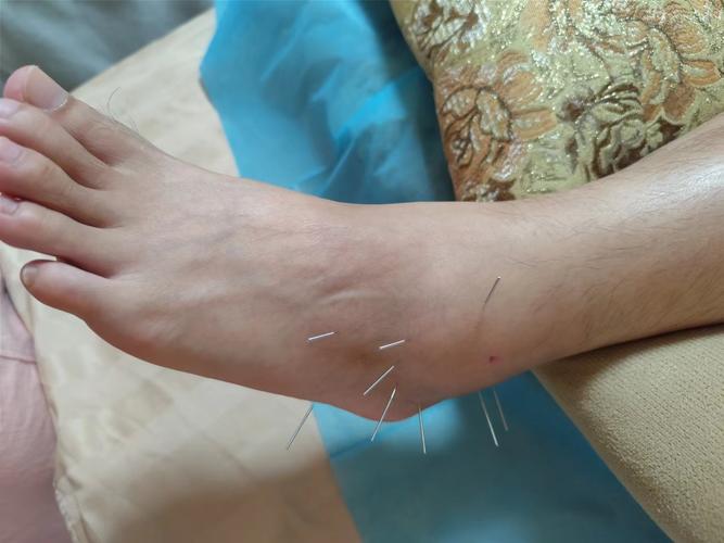 痛风应该扎什么穴位