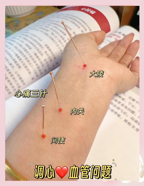 痛风应该扎什么穴位