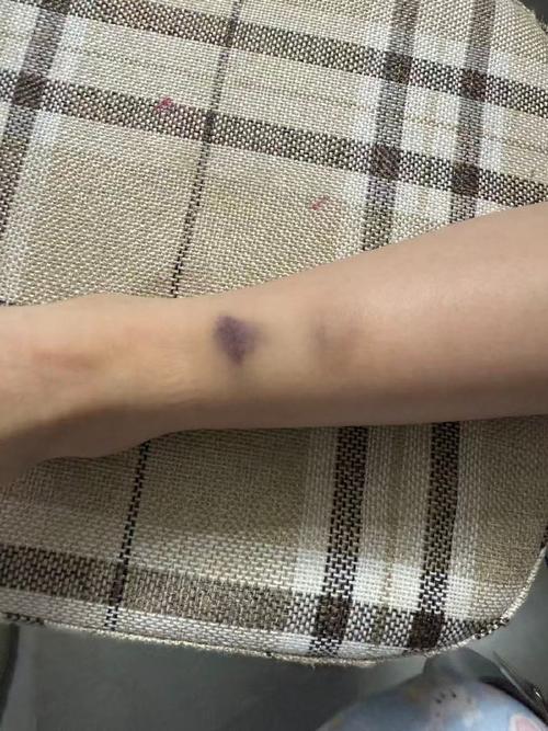 按摩穴位后出现乌青