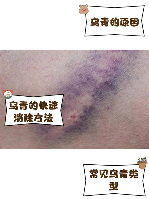 按摩穴位后出现乌青